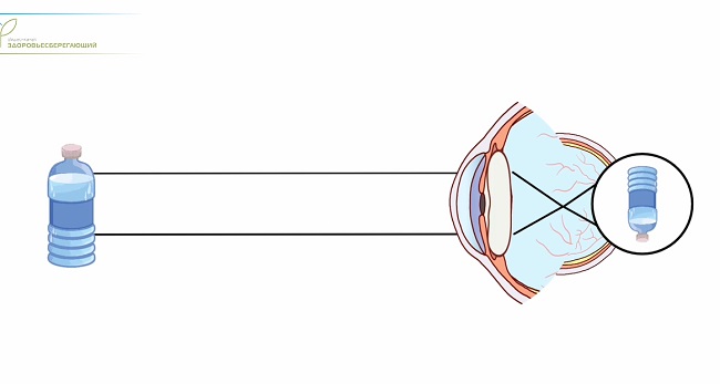 Нарушения зрения