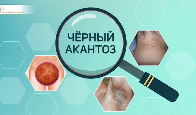 черный акантоз