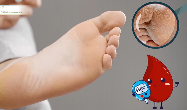 сухость кожи на ступнях