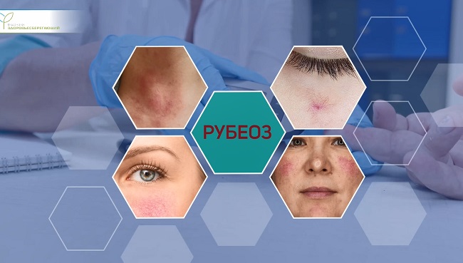 рубеоз