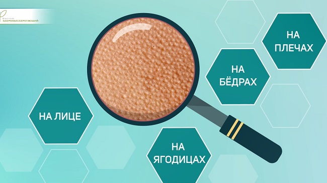 волосяной лишай