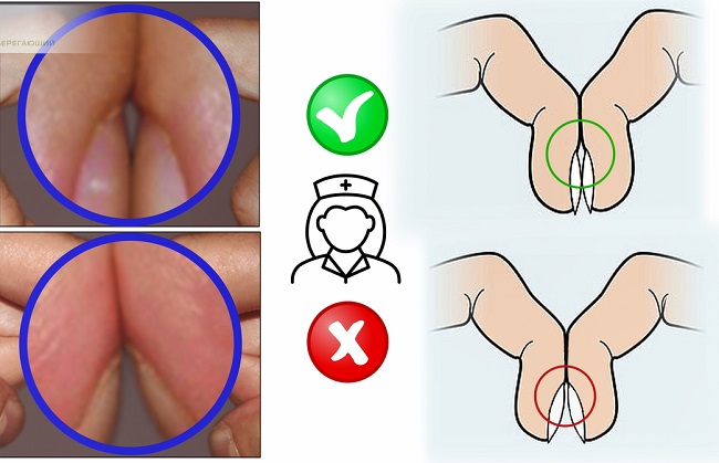 симптом барабанных палочек