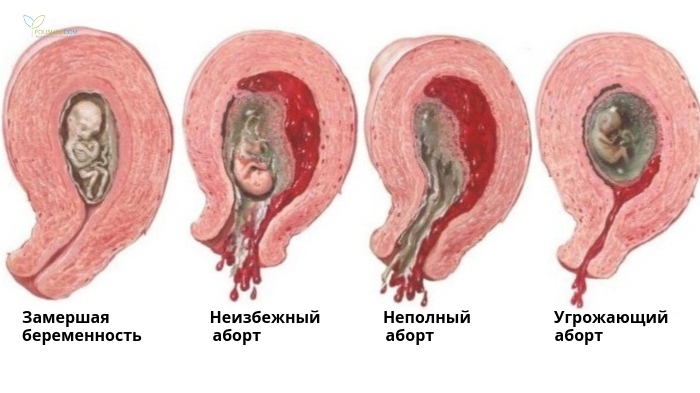 Замершая беременность и стадии выкидыша
