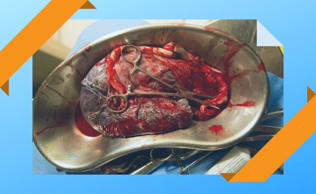 Плацента после родов