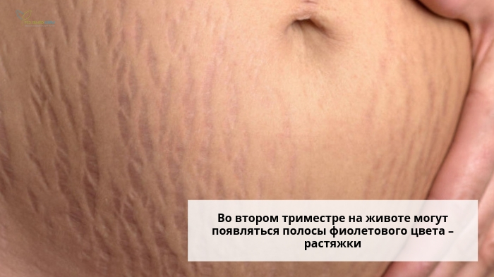 Растяжки у беременной