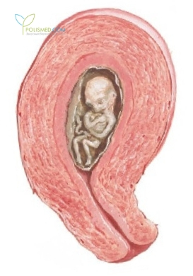 Замершая беременность