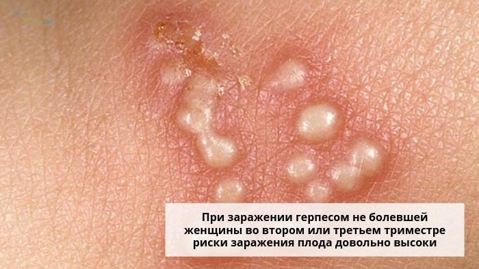 Сыпь при герпесе
