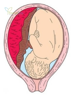 Отслойка плаценты