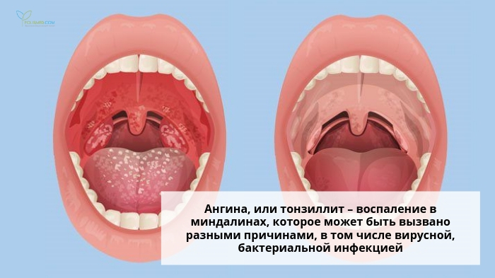 Горло и язык при ангине