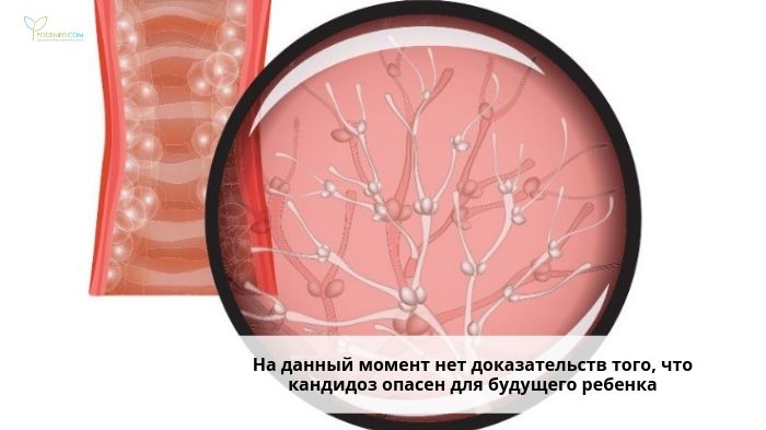 Вагинальный кандидоз