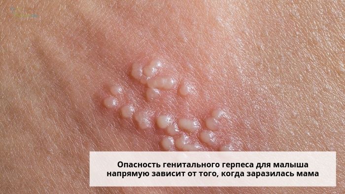 Герпетическая сыпь