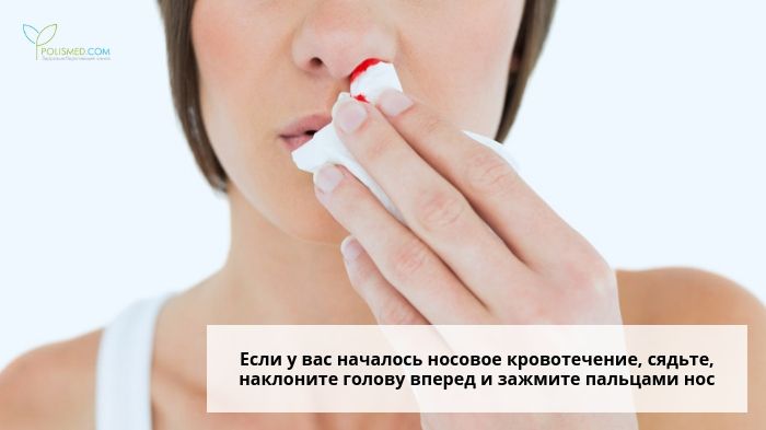 Кровотечение из носа