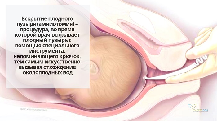 Вскрытие плодного пузыря с помощью специального инструмента
