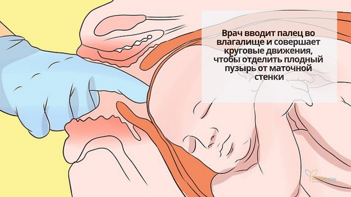 Ручное отделение плодного пузыря от стенки матки