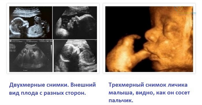 УЗ-снимки плода