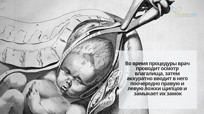 Родоразрешение с помощью акушерских щипцов