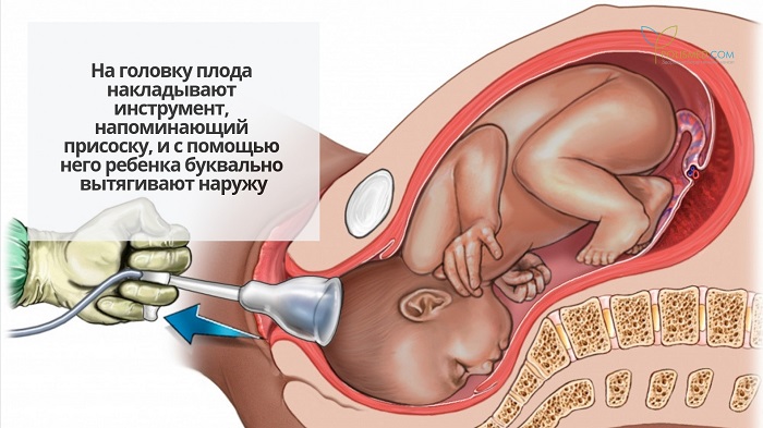 Родоразрешение с помощью вакуумной экстракции