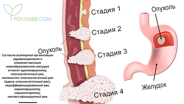 Стадии аденокарциномы желудка