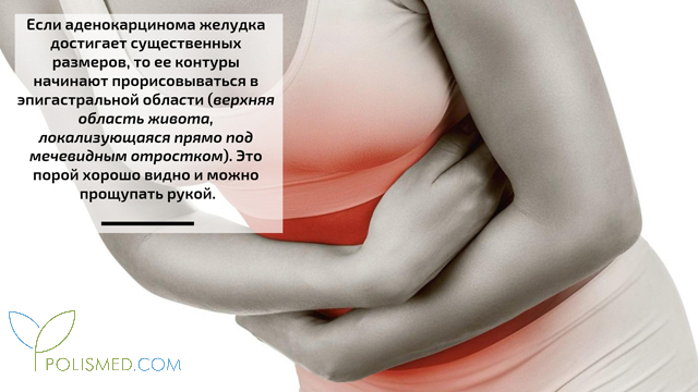 Диагностика аденокарциномы желудка