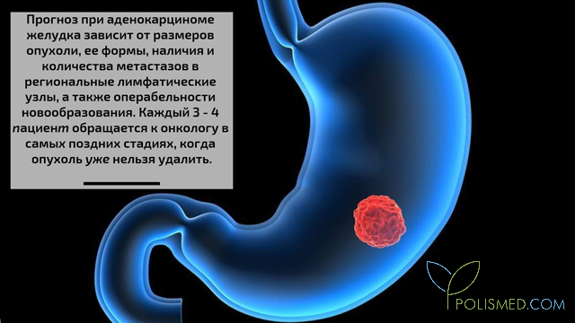 Прогноз при аденокарциноме желудка