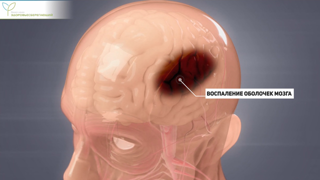 Менингит