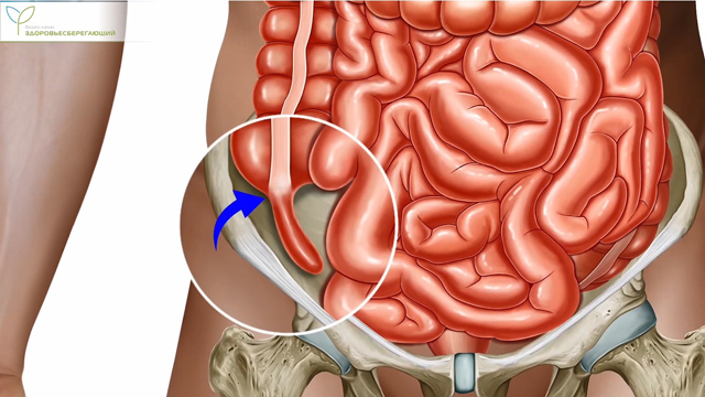 Аппендицит