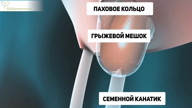 Паховая грыжа