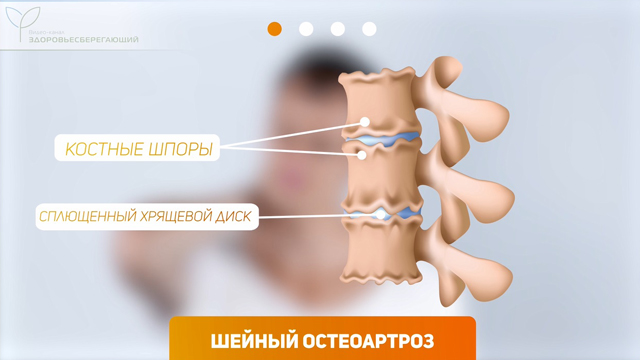 Шейный остеоартроз