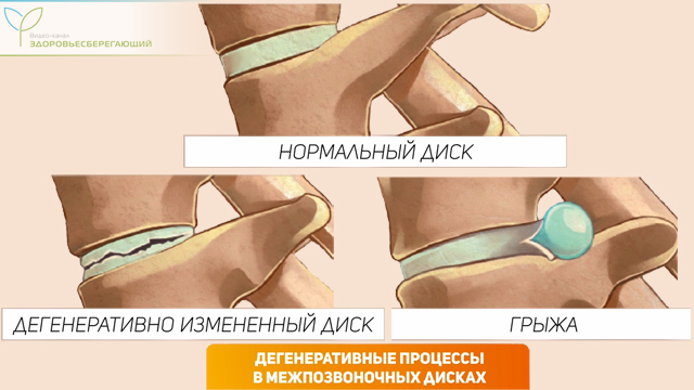 Дегенеративные процессы в межпозвоночных дисках