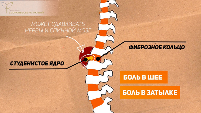 Межпозвоночные грыжи