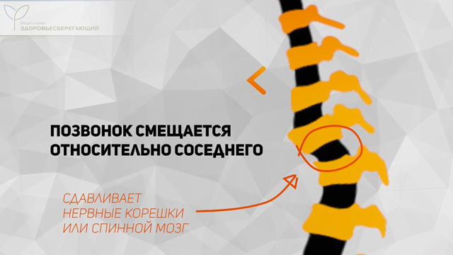 Спондилолистез