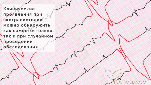 Экстрасистолия как ощущается