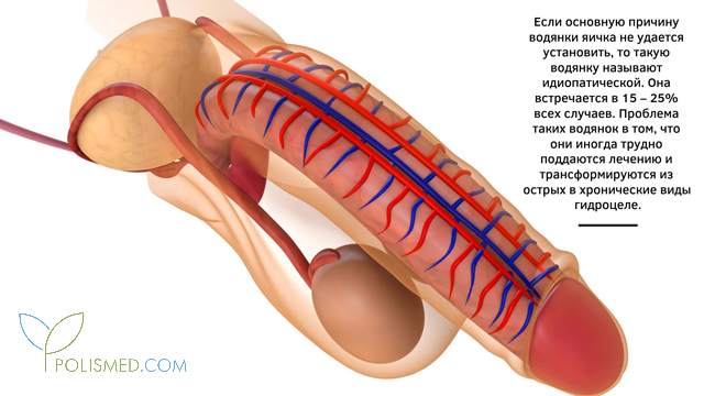 Формы и стадии водянки яичка