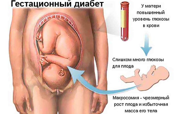 Гестационный диабет