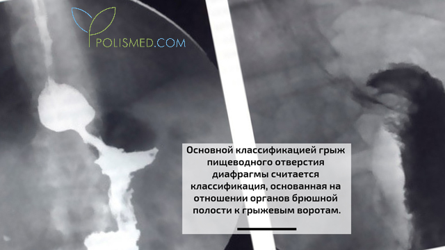 Хиатальная грыжа 1 степени что. Смотреть фото Хиатальная грыжа 1 степени что. Смотреть картинку Хиатальная грыжа 1 степени что. Картинка про Хиатальная грыжа 1 степени что. Фото Хиатальная грыжа 1 степени что
