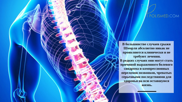 Грыжа Шморля