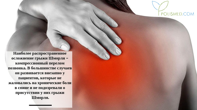 Опасность грыжы Шморля