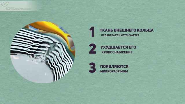 Изнашивание диска