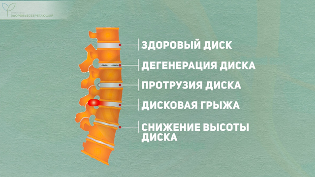 Образование грыжи