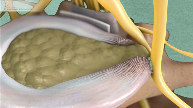 Грыжа позвоночника