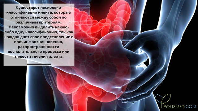 Классификация илеита