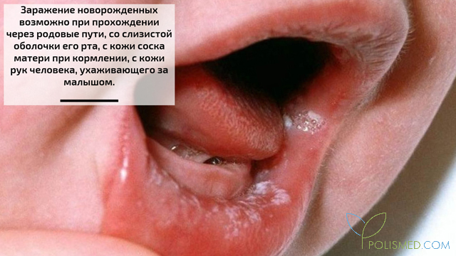 Кандидоз у новорожденных