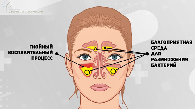 Воспалительный процесс