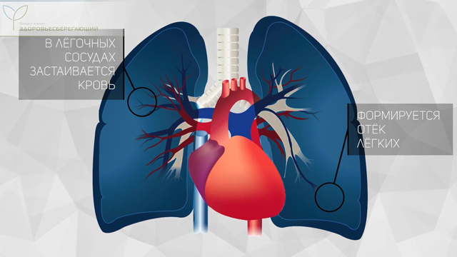 Отек легких