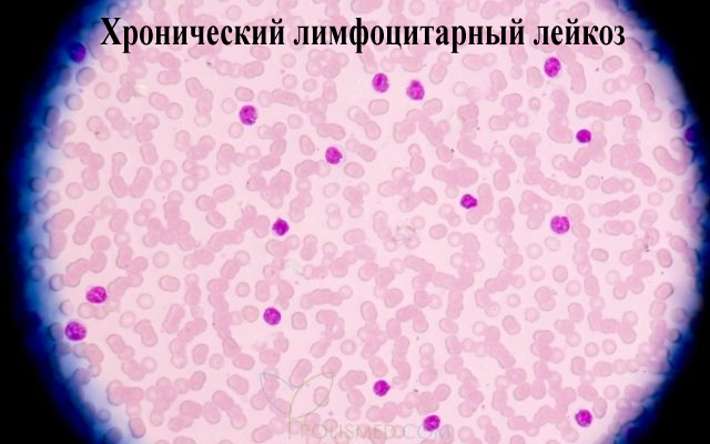 что делать если увеличился лимфатический узел. Смотреть фото что делать если увеличился лимфатический узел. Смотреть картинку что делать если увеличился лимфатический узел. Картинка про что делать если увеличился лимфатический узел. Фото что делать если увеличился лимфатический узел