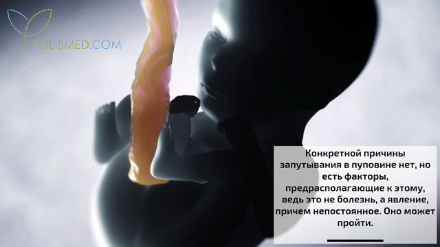 Что значит обвитие пуповины вокруг шеи плода. Смотреть фото Что значит обвитие пуповины вокруг шеи плода. Смотреть картинку Что значит обвитие пуповины вокруг шеи плода. Картинка про Что значит обвитие пуповины вокруг шеи плода. Фото Что значит обвитие пуповины вокруг шеи плода