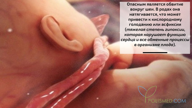 Что значит обвитие пуповины вокруг шеи плода. Смотреть фото Что значит обвитие пуповины вокруг шеи плода. Смотреть картинку Что значит обвитие пуповины вокруг шеи плода. Картинка про Что значит обвитие пуповины вокруг шеи плода. Фото Что значит обвитие пуповины вокруг шеи плода