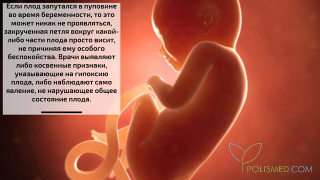 Что значит обвитие пуповины вокруг шеи плода. Смотреть фото Что значит обвитие пуповины вокруг шеи плода. Смотреть картинку Что значит обвитие пуповины вокруг шеи плода. Картинка про Что значит обвитие пуповины вокруг шеи плода. Фото Что значит обвитие пуповины вокруг шеи плода