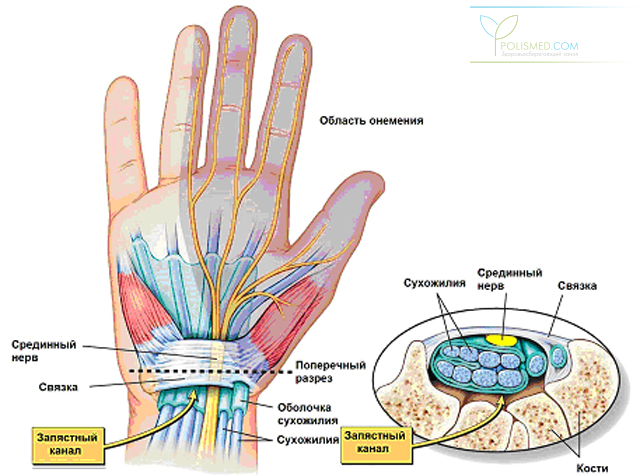 Туннельный синдром