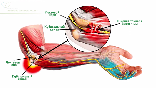 Синдром кубитального канала
